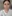 裏ハムラ法（経結膜的眼窩脂肪移動術） — ジャスト美容外科クリニック