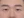 incisional double eyelid surgery — before (3days) · J.O. Plastic Surgery Clinic