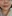 Lip filler (lip augmentation with HA) — Dress Plastic Surgery Clinic