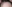 額縮小術（生え際下げ・ヘアライン下降術） — コウユ美容外科クリニック