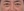 lower blepharoplasty (under-eye bag removal with fat repositioning) — before (7days) · Steady Plastic Surgery Clinic
