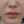 โบท็อกซ์ร่นร่องริมฝีปาก (Lip Flip ทำให้ร่องใต้จมูกดูสั้นลง) — ก่อนทำ (7วัน) · คลินิก Younme