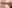 Arm liposuction — Dr. Mango Clinic