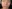 Augmentation rhinoplasty for a low/flat nasal bridge — Cowon Plastic Surgery Clinic