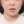 下巴異物取出（下巴假體移除） — 術後 (60天) · Returning醫美診所