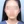 ผ่าตัดลดโหนกแก้มแบบเร็ว (ไม่ใส่ตัวยึด) — หลังทำ (90วัน) · ยูโนพลาสติกเซอร์เจอรี่