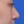 ผ่าตัดแก้ไขผนังกั้นช่องจมูกคด (Septoplasty) — หลังทำ (14วัน) · คลินิกโคบิจู