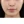 Ultraformer MPT (อัลตร้าฟอร์เมอร์ เอ็มพีที) — หลังทำ · คลินิกเบด