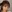糸リフト（スレッドリフト） — ジャスト美容外科クリニック