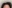 額縮小術（生え際下げ・ヘアライン下降術） — ザフィックス美容外科クリニック