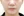 Paranasal (nasal base) augmentation with implant — before (30days) · Apgujeong Lee & Star Clinic