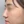 Nose tip filler — before · Erne Clinic