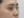 Nasal tip augmentation with implant — before (7days) · The Ollim Plastic Surgery Clinic