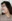 Bulbous nose correction (surgical nasal tip reduction) — Marvel Plastic Surgery Clinic