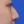 ผ่าตัดแก้ไขผนังกั้นช่องจมูกคด (Septoplasty) — ก่อนทำ (14วัน) · คลินิกโคบิจู