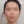 太阳穴自体脂肪填充 — 术后 (13天) · The整形外科