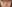 糸リフト（スレッドリフト） — ミケイ美容外科