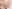 糸リフト（スレッドリフト） — バランスラボ美容外科クリニック