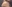額縮小術（生え際下げ・ヘアライン下降術） — ララ美容外科クリニック