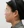 ฉีดสลายไขมันหน้า (เมโสแฟตแก้ม) — หลังทำ · ศูนย์ศัลยกรรม Zero - สาขาชินซา