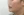 ตัดไขมันกระพุ้งแก้ม — ก่อนทำ (9วัน) · ไอรูมิ ศัลยกรรมพลาสติก