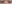 二重まぶた（自然癒着法） — プロミス美容外科クリニック