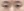 incisional double eyelid surgery — before (7days) · iLumi Plastic Surgery Clinic
