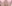鼻尖形成術（自家軟骨移植） — エイト美容外科クリニック