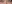 裏ハムラ法（経結膜的眼窩脂肪移動術） — プレジャー美容外科クリニック