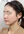 two-jaw surgery (bimaxillary orthognathic surgery) — after (90days) · A-Top Plastic Surgery Clinic