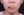 ยกกระชับ V-shape ด้วย HIFU (Shurink / Ultraformer III) — หลังทำ (30วัน) · เอท ศัลยกรรมพลาสติก
