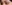 切開法（全切開法二重術） — セギム美容外科クリニック