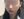 顴骨肉毒桿菌注射 — 術後 (7天) · U-Line醫美診所