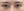 incisional double eyelid surgery — after (7days) · iLumi Plastic Surgery Clinic