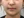 ยกกระชับ V-shape ด้วย HIFU (Shurink / Ultraformer III) — หลังทำ (30วัน) · Monster Clinic
