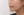 ตัดไขมันกระพุ้งแก้ม — หลังทำ (9วัน) · ไอรูมิ ศัลยกรรมพลาสติก
