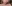 Double chin liposuction (submental liposuction) — Uri Plastic Surgery Clinic