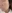 ピコトーニング — ユーアンドアイクリニック-明洞店