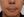 JUVGEN (autologous dermal regeneration / collagen-induction injection) — after (14days) · Saeroun Plastic Surgery