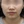 TuneLiner (non-invasive ultrasound fat reduction & contouring) — before (28days) · J.Fill Clinic - Gangnam Branch