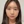 皮質骨切除術（下顎外板骨切り） — 術前 (90日) · エイビー美容外科クリニック