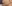 人中短縮（リップリフト） — ハイボム美容外科クリニック