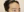 Forehead reduction (hairline lowering surgery) — before (10days) · The Fix Plastic Surgery Clinic