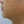 Surfect Lifting (4MHz monopolar RF lifting) — after (90days) · Only Lift Clinic