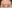 upper blepharoplasty (upper eyelid lift) — Oneul Plastic Surgery Clinic