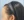 Scalp hair transplant — before (7days) · Do Jagi Clinic