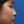 ผ่าตัดแก้ไขภาวะลิ้นจมูกตีบ/ยุบ (Nasal valve stenosis) — หลังทำ (30วัน) · บีเอส (BS) ซูมี โสต ศอ นาสิก