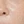 Clarity II (Lutronic dual-wavelength laser) — after (60days) · A-Top Plastic Surgery Clinic