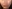 頬（ほお）の脂肪注入 — 一空公美容外科クリニック