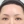 内視鏡下額（前額）リフト（エンドタイン固定） — 術後 (7日) · エイビー美容外科クリニック